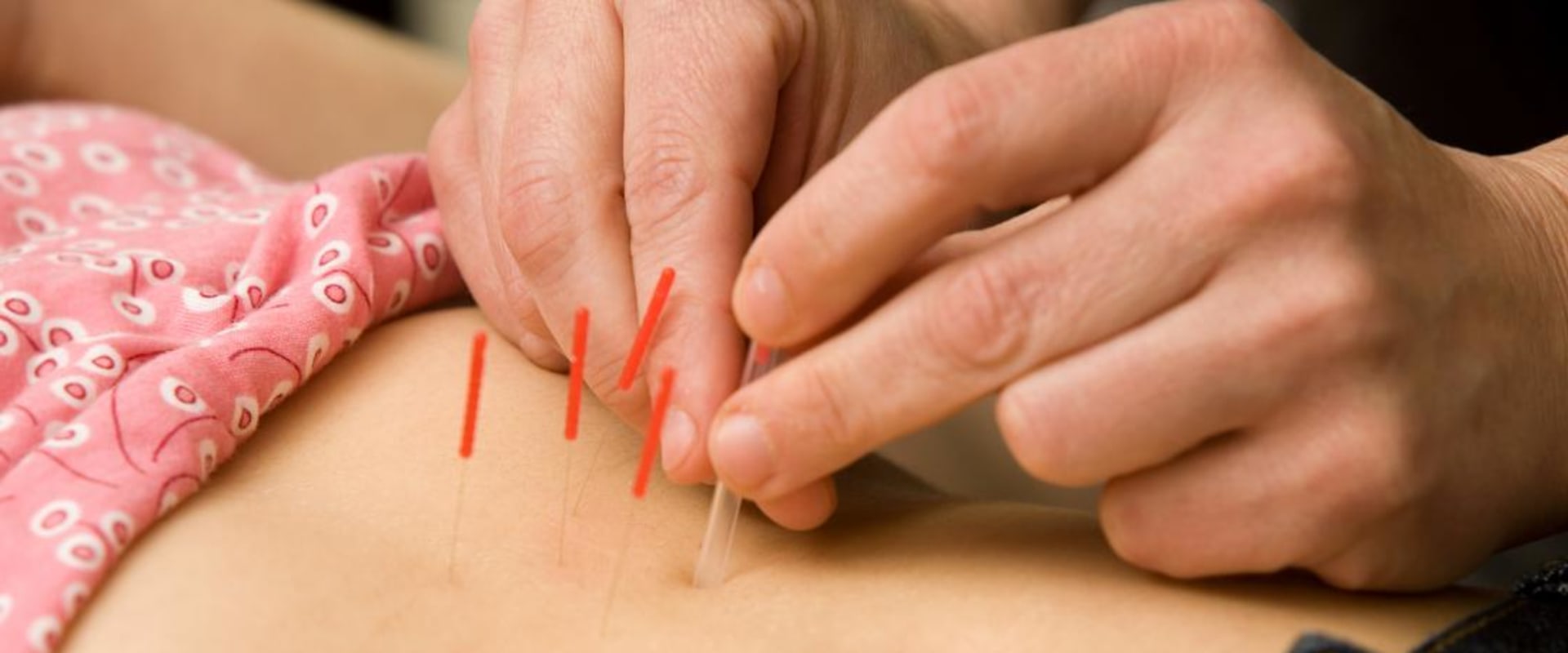 Understanding the Benefits of Acupuncture for Fertility