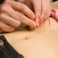 Understanding the Benefits of Acupuncture for Fertility