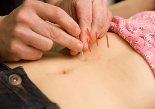 Understanding the Benefits of Acupuncture for Fertility